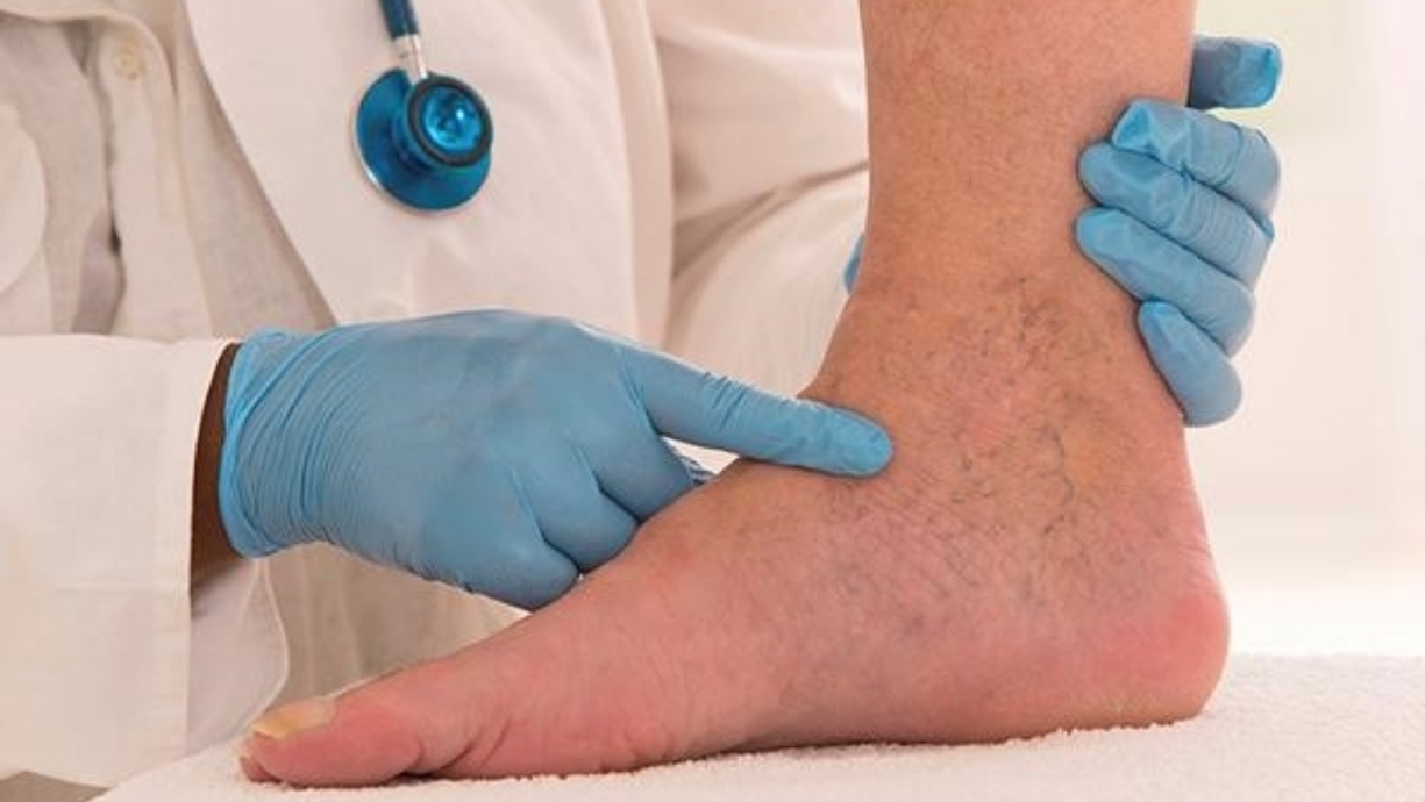 علائم واریس را بشناسید؛ از سردی و سنگینی پا‌ها تا خارش و تورم